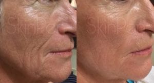 SkinPen Microneedling WrinKles ageing