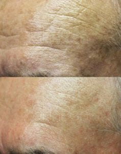 SkinPen microneedling Ageing lines wrinkles