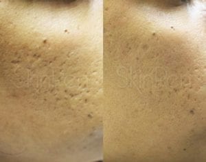SkinPen Microneedling Acne Scarring Pigmentation